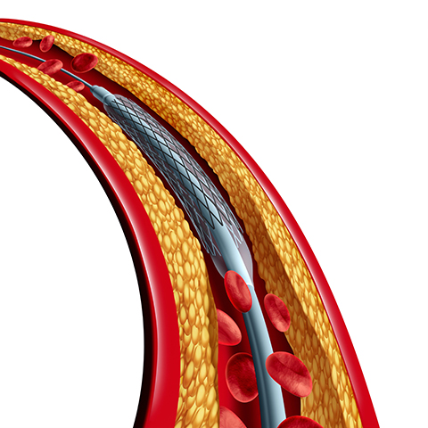 Drug-Coated Cobalt-Chrome Coronary Stents